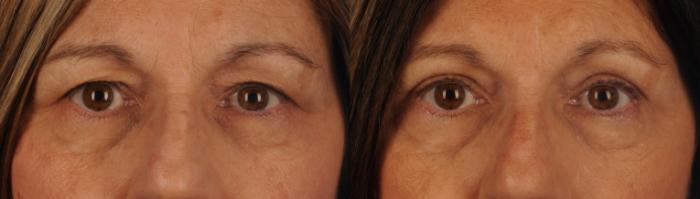 Before & After Blepharoplasty Case 151 View #1 View in Toronto, ON