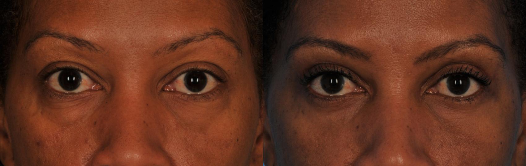 Before & After Blepharoplasty Case 152 View #1 View in Toronto, ON
