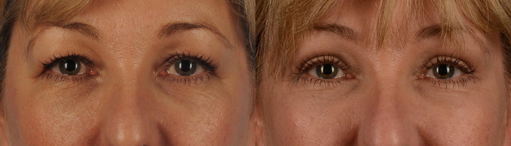 Before & After Blepharoplasty Case 153 View #1 View in Toronto, ON