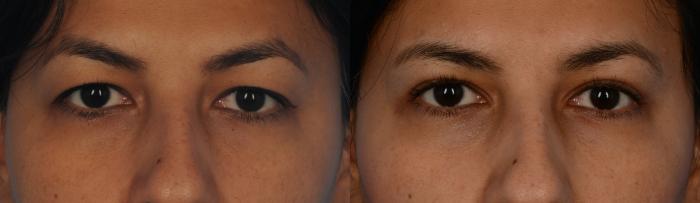 Before & After Blepharoplasty Case 154 View #1 View in Toronto, ON