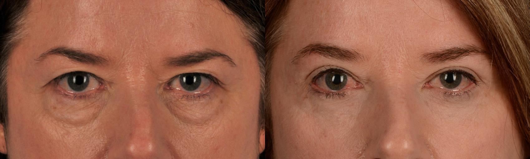 Before & After Blepharoplasty Case 156 View #1 View in Toronto, ON