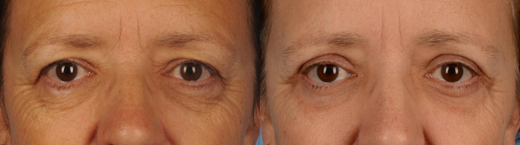 Before & After Blepharoplasty Case 157 View #1 View in Toronto, ON