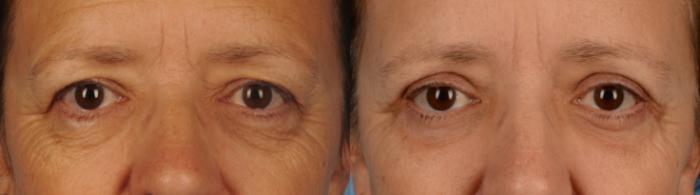 Before & After Blepharoplasty Case 157 View #1 View in Toronto, ON