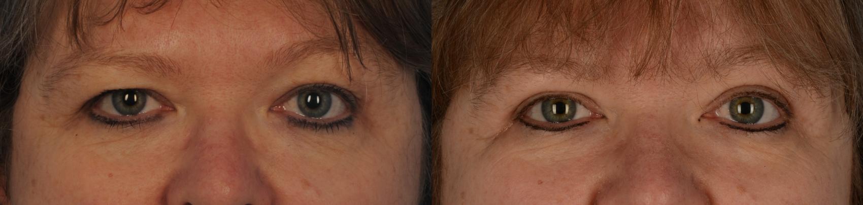 Before & After Blepharoplasty Case 159 View #1 View in Toronto, ON