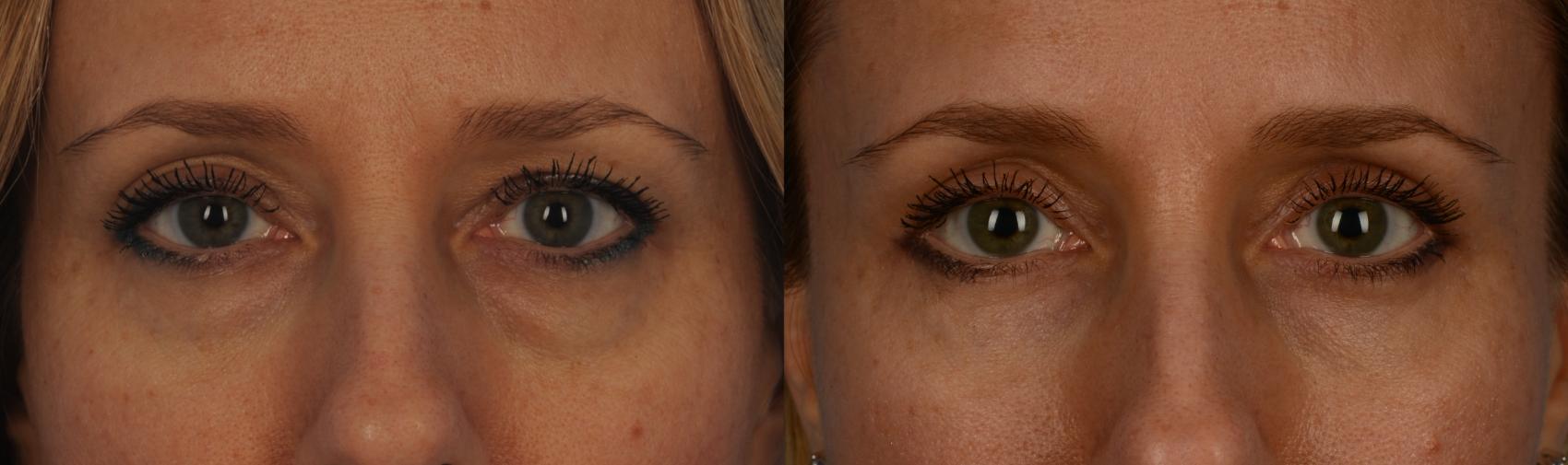 Before & After Blepharoplasty Case 161 View #1 View in Toronto, ON