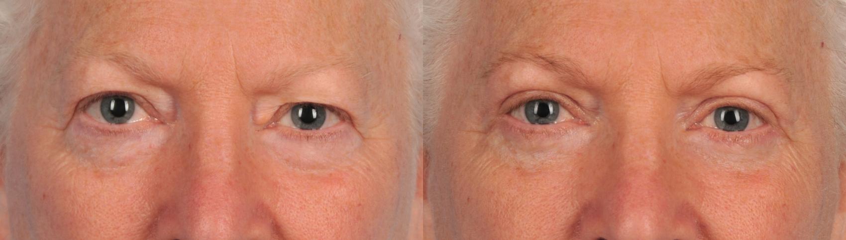 Before & After Blepharoplasty Case 162 View #1 View in Toronto, ON