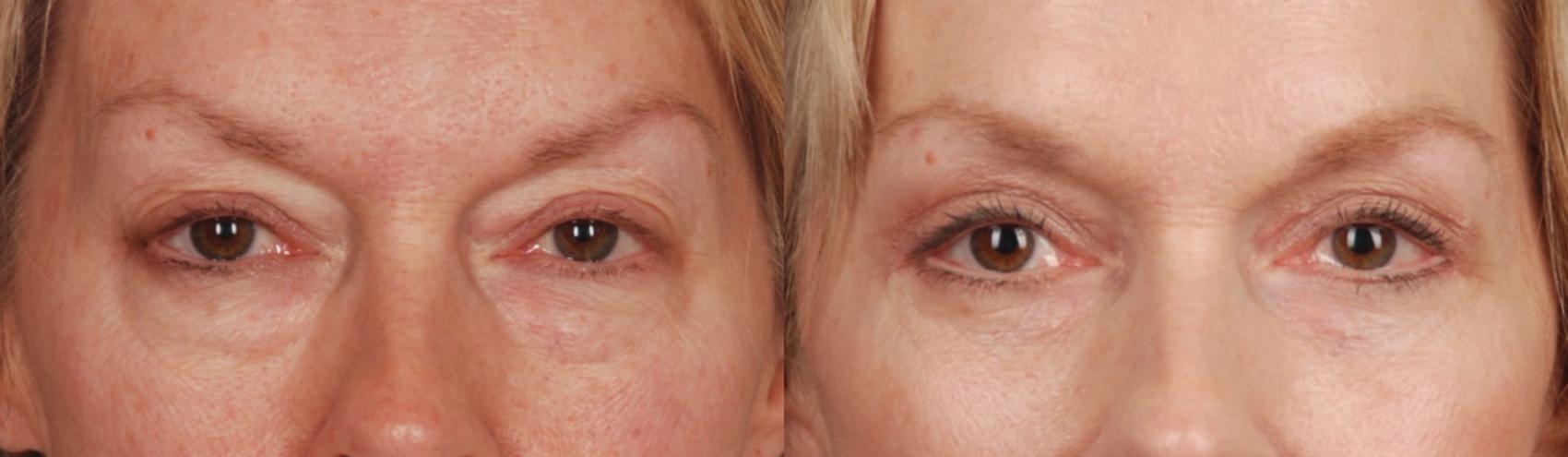 Before & After Blepharoplasty Case 163 View #1 View in Toronto, ON