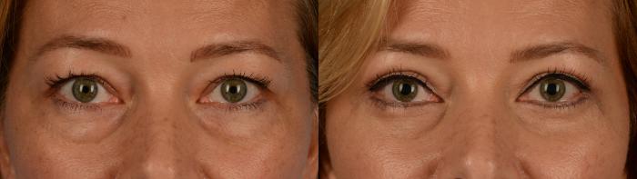 Before & After Blepharoplasty Case 174 View #1 View in Toronto, ON