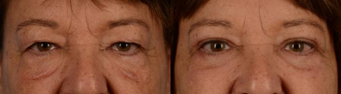 Before & After Blepharoplasty Case 175 View #1 View in Toronto, ON