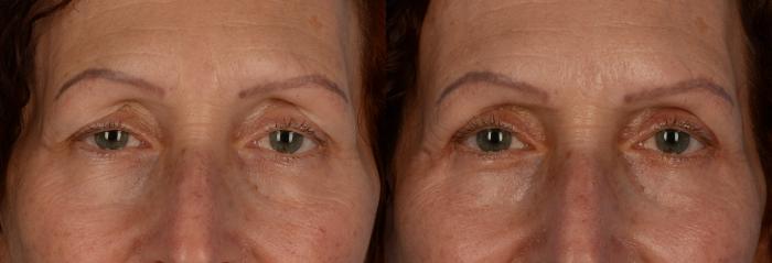 Before & After Blepharoplasty Case 176 View #1 View in Toronto, ON