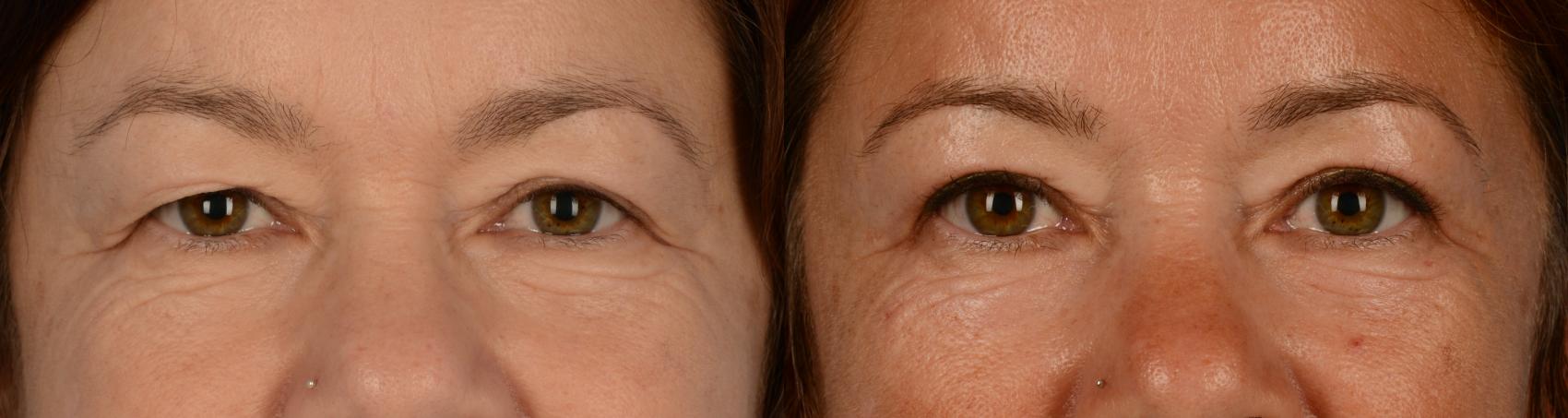 Before & After Blepharoplasty Case 181 View #1 View in Toronto, ON
