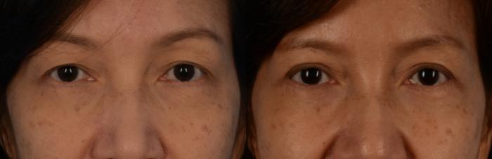 Before & After Blepharoplasty Case 182 View #1 View in Toronto, ON