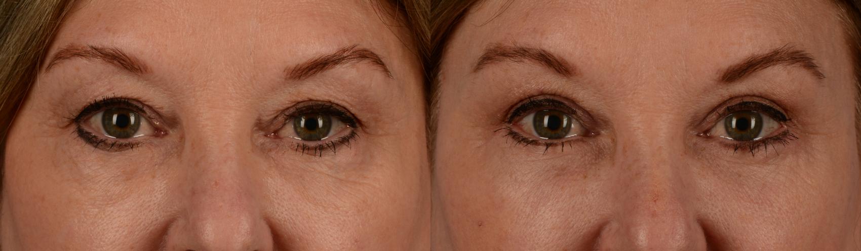 Before & After Blepharoplasty Case 185 View #1 View in Toronto, ON