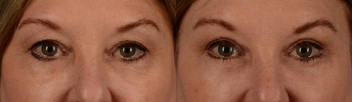 Before & After Blepharoplasty Case 185 View #1 View in Toronto, ON