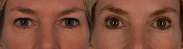 Before & After Blepharoplasty Case 186 View #1 View in Toronto, ON