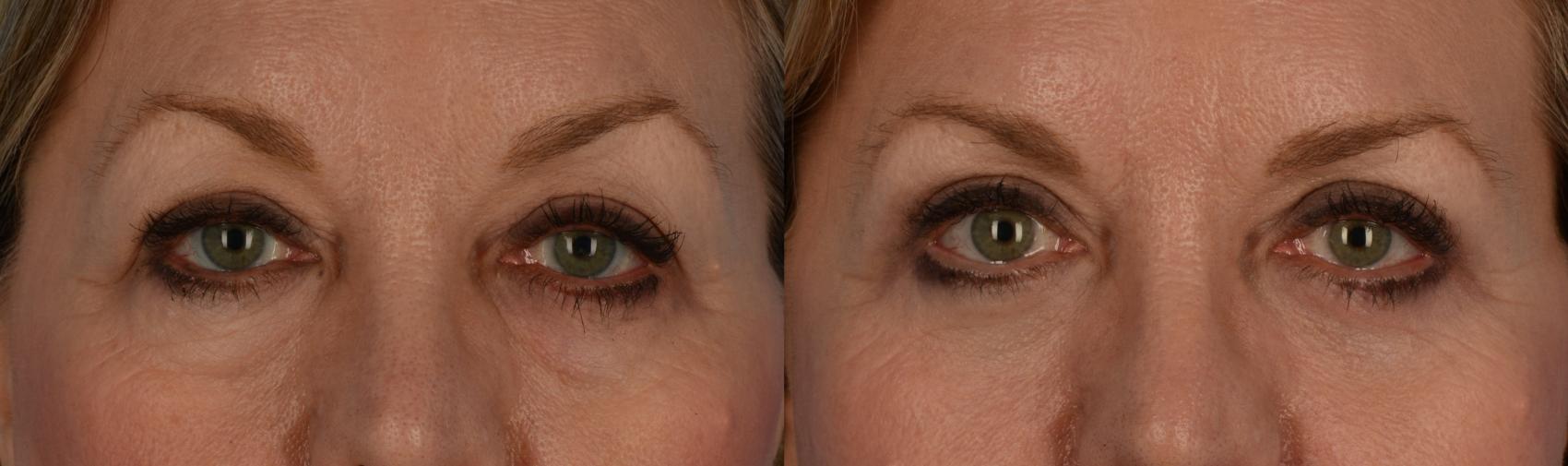 Before & After Blepharoplasty Case 187 View #1 View in Toronto, ON