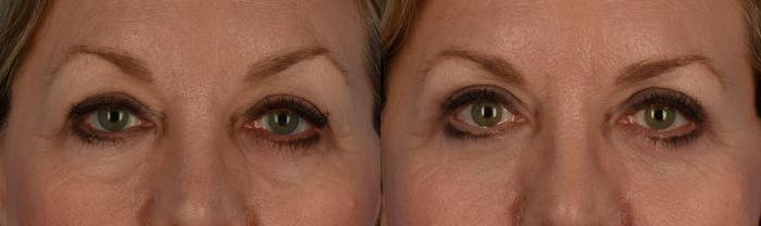 Before & After Blepharoplasty Case 187 View #1 View in Toronto, ON
