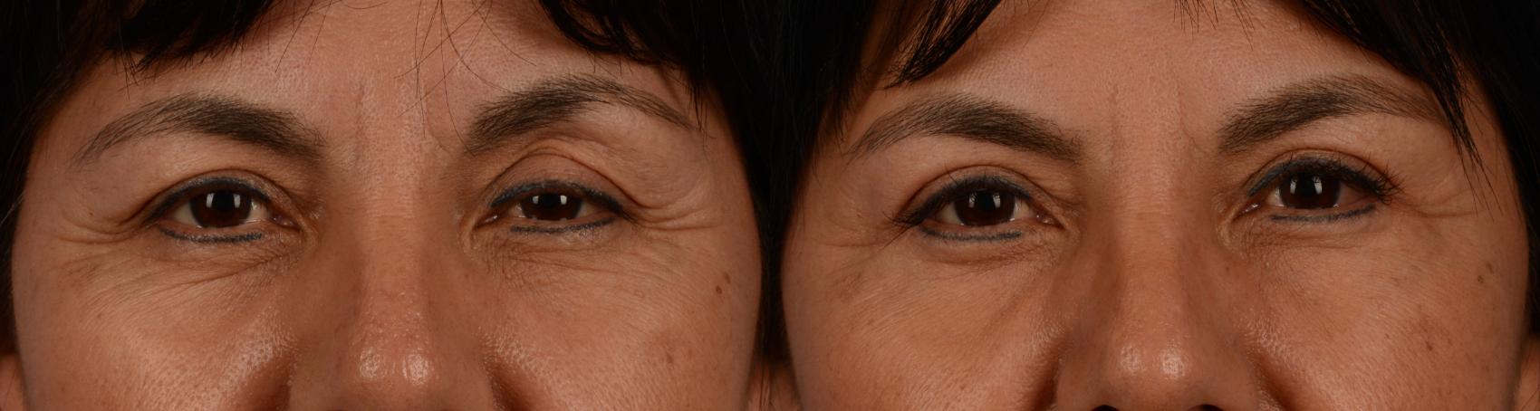 Before & After Blepharoplasty Case 188 View #1 View in Toronto, ON