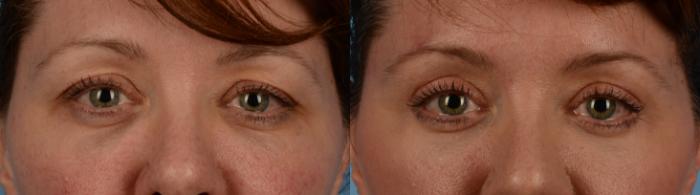 Before & After Blepharoplasty Case 190 View #1 View in Toronto, ON