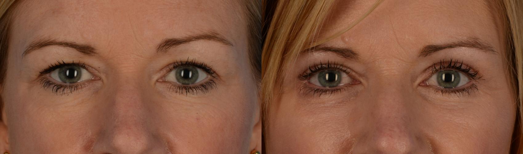 Before & After Blepharoplasty Case 193 View #1 View in Toronto, ON