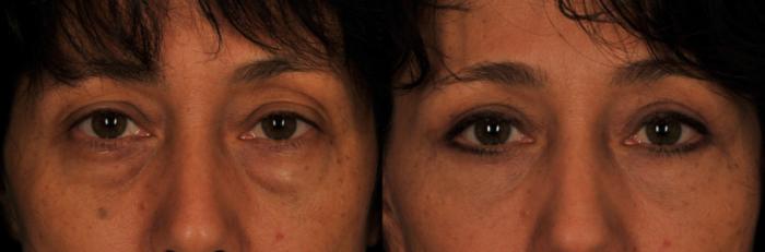 Before & After Blepharoplasty Case 194 View #1 View in Toronto, ON