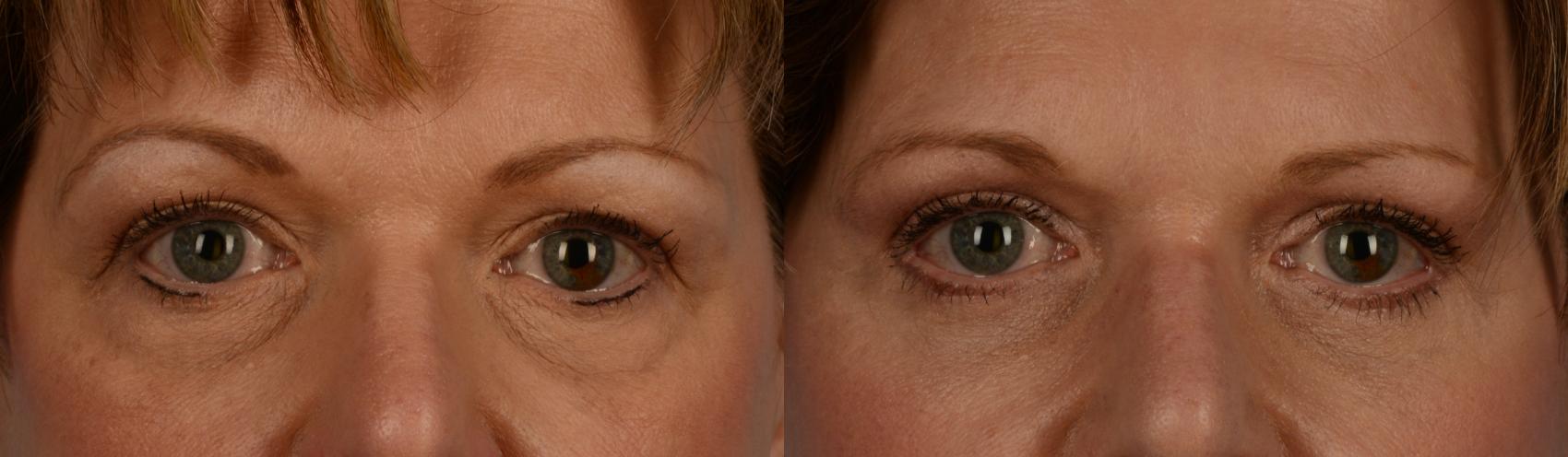 Before & After Blepharoplasty Case 199 View #1 View in Toronto, ON
