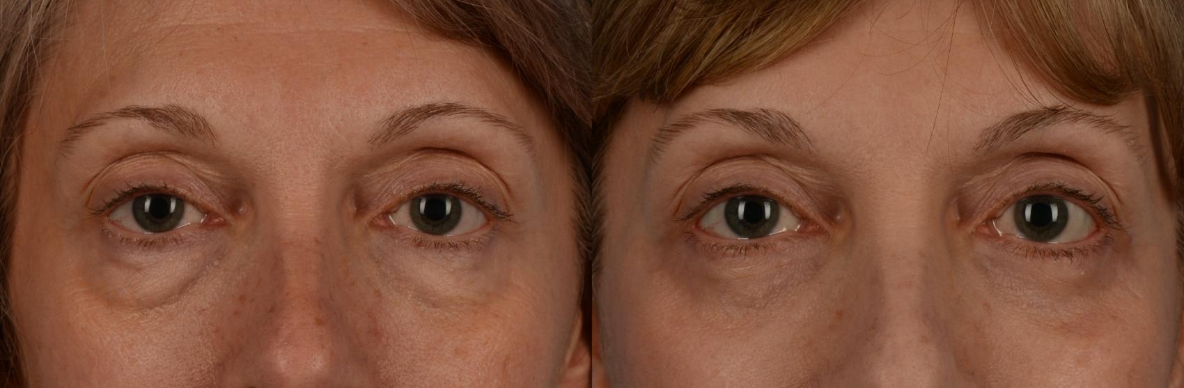 Before & After Blepharoplasty Case 200 View #1 View in Toronto, ON