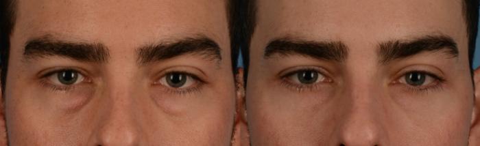 Before & After Blepharoplasty Case 210 View #1 View in Toronto, ON