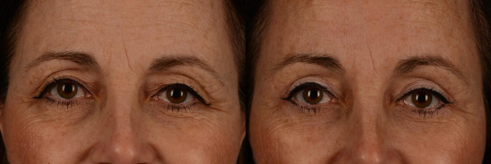 Before & After Brow Lift Case 211 View #1 View in Toronto, ON