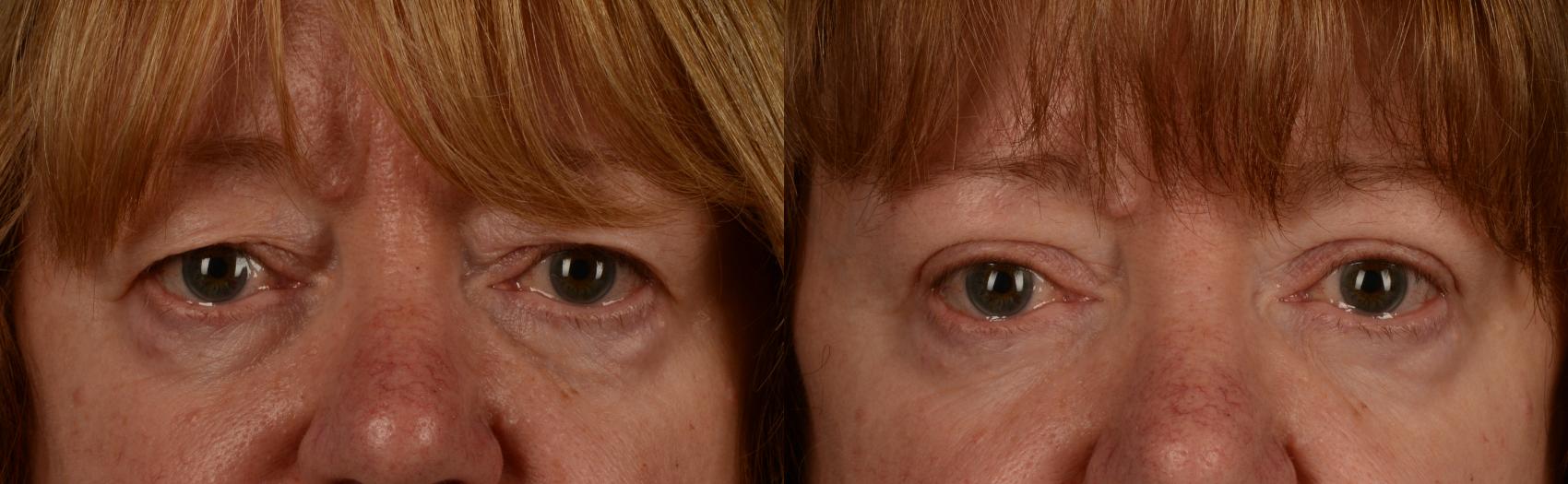 Before & After Blepharoplasty Case 214 View #1 View in Toronto, ON