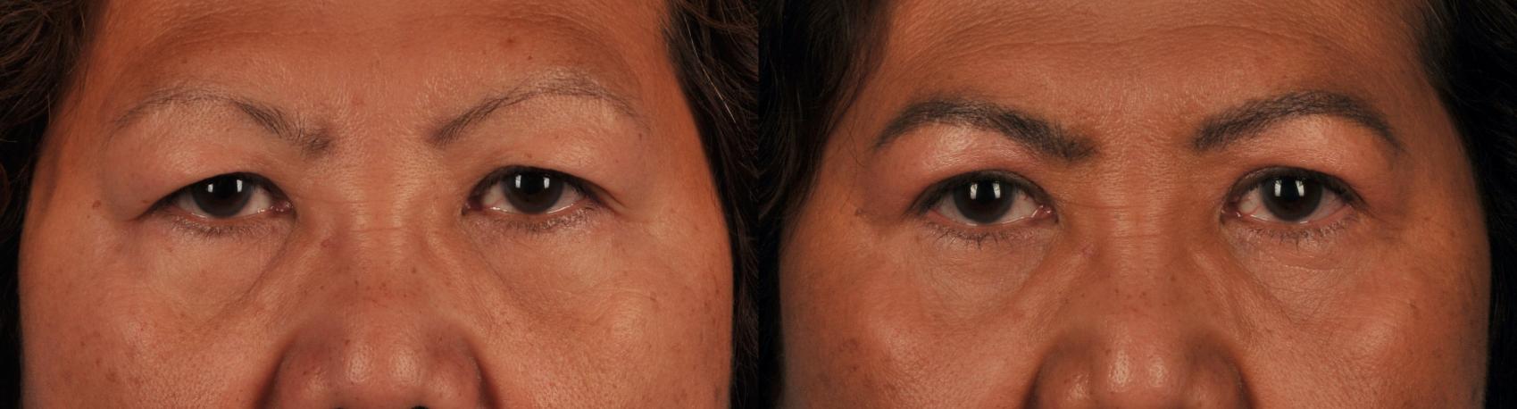 Before & After Blepharoplasty Case 217 View #1 View in Toronto, ON