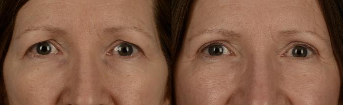 Before & After Blepharoplasty Case 218 View #1 View in Toronto, ON