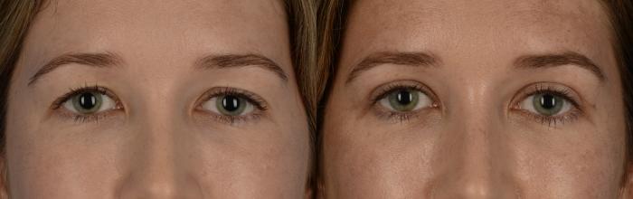 Before & After Blepharoplasty Case 219 View #1 View in Toronto, ON
