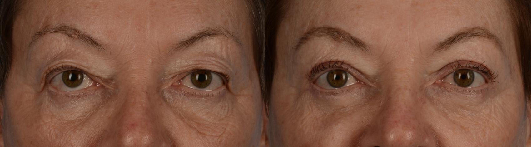 Before & After Blepharoplasty Case 223 View #1 View in Toronto, ON