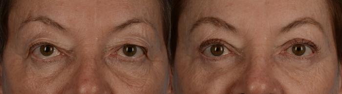 Before & After Blepharoplasty Case 223 View #1 View in Toronto, ON