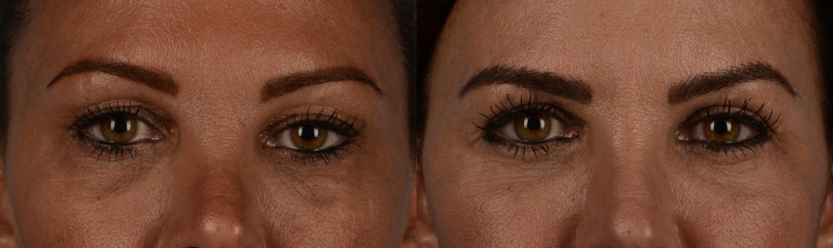 Before & After Blepharoplasty Case 227 View #1 View in Toronto, ON