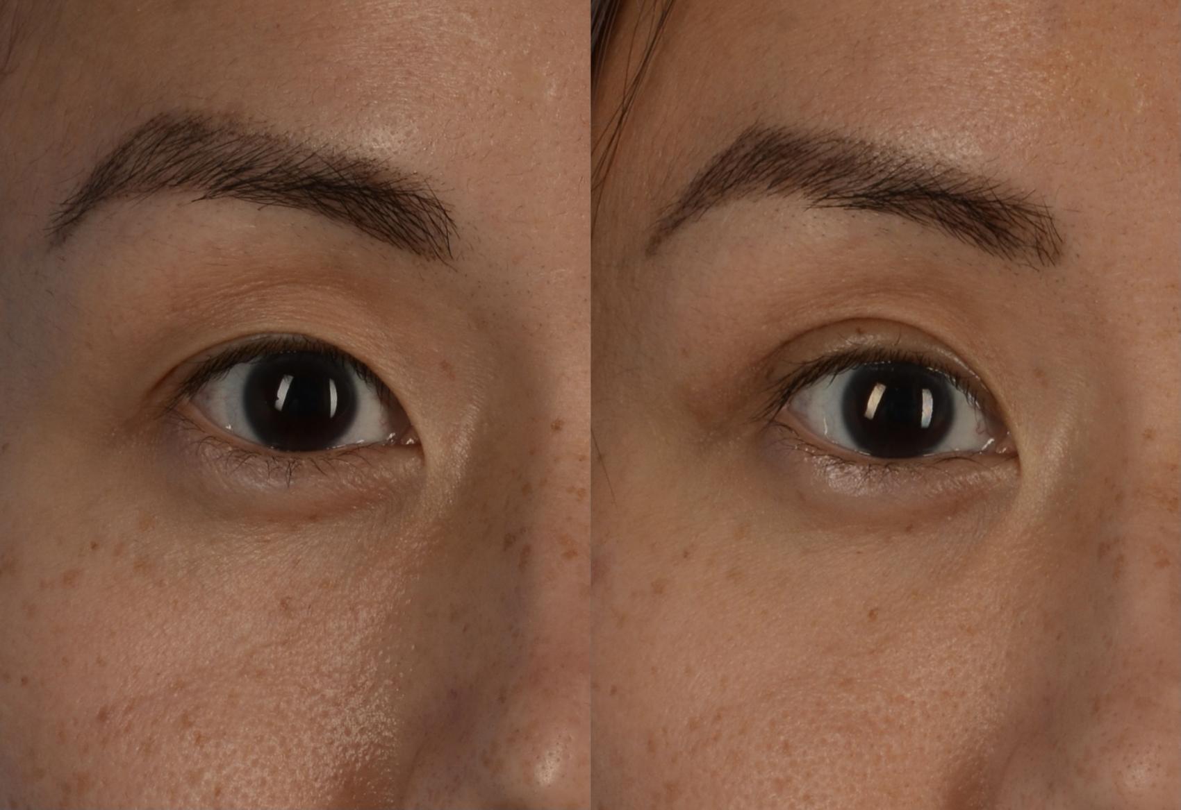Before & After Blepharoplasty Case 228 View #1 View in Toronto, ON