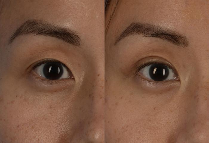 Before & After Blepharoplasty Case 228 View #1 View in Toronto, ON