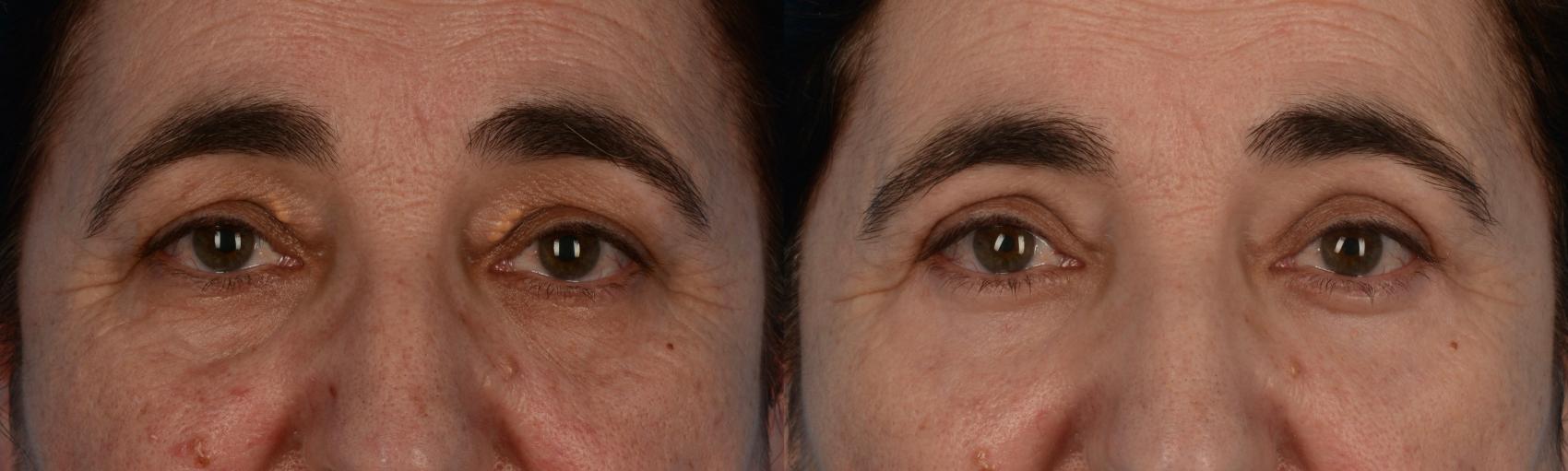 Before & After Blepharoplasty Case 238 View #1 View in Toronto, ON