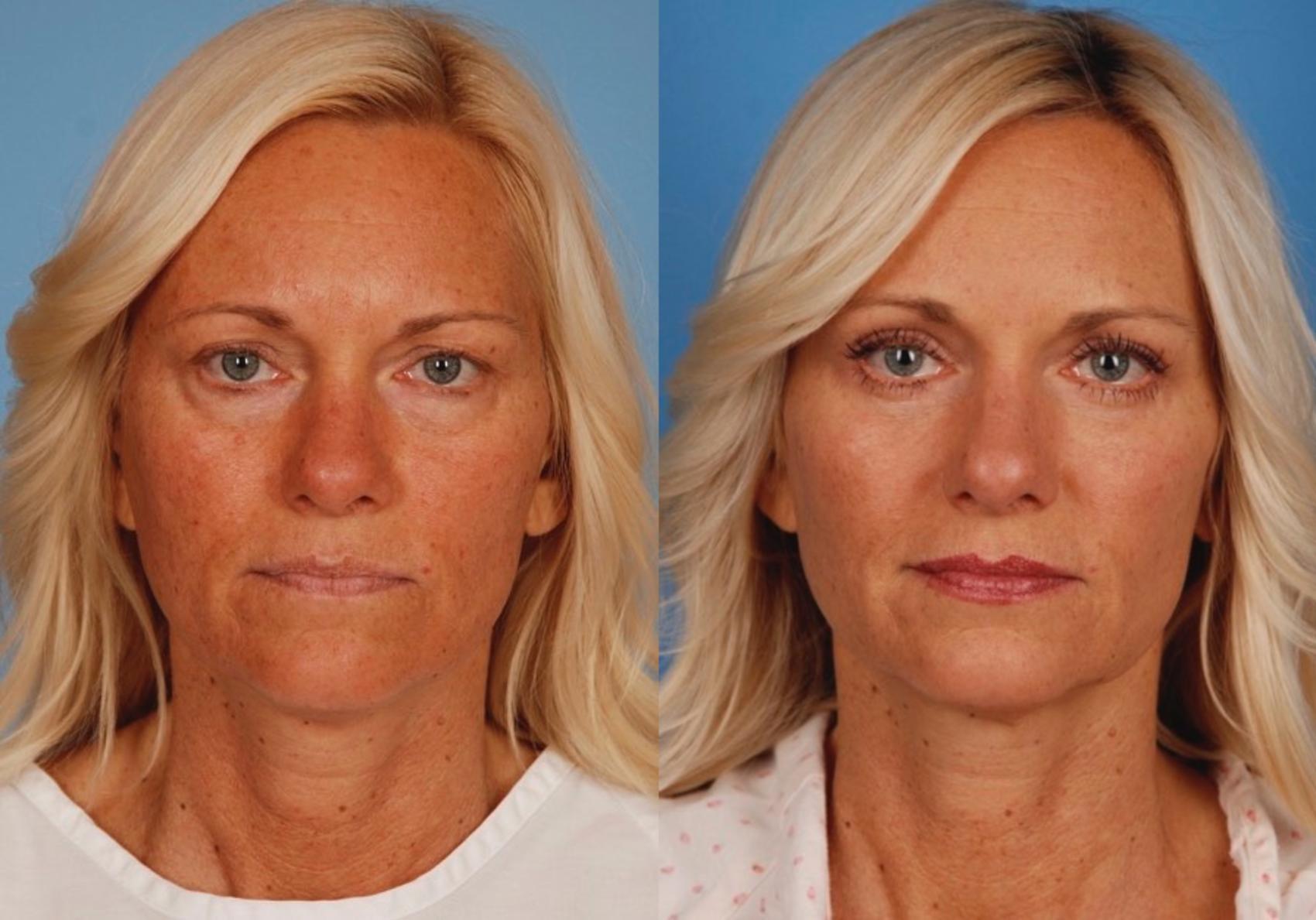 Before & After Blepharoplasty Case 24 View #1 View in Toronto, ON