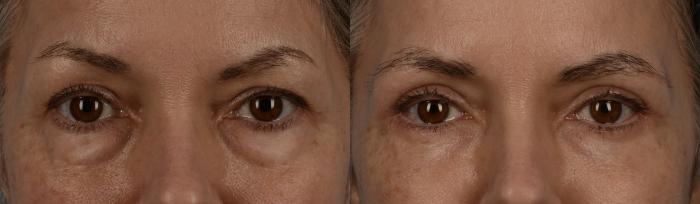 Before & After Blepharoplasty Case 242 Front View in Toronto, ON