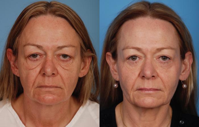 Before & After Blepharoplasty Case 25 View #1 View in Toronto, ON