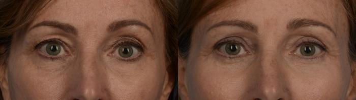 Upper and Lower Blepharoplasty with Fat Grafting to Upper Cheeks
