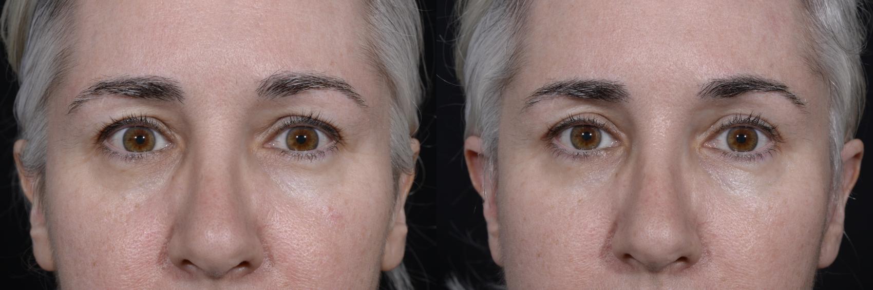 Before & After Blepharoplasty Case 271 Front View in Toronto, ON