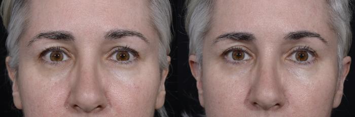 Before & After Blepharoplasty Case 271 Front View in Toronto, ON