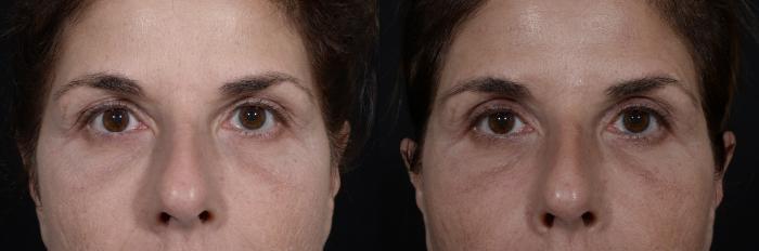 Before & After Blepharoplasty Case 272 Front View in Toronto, ON