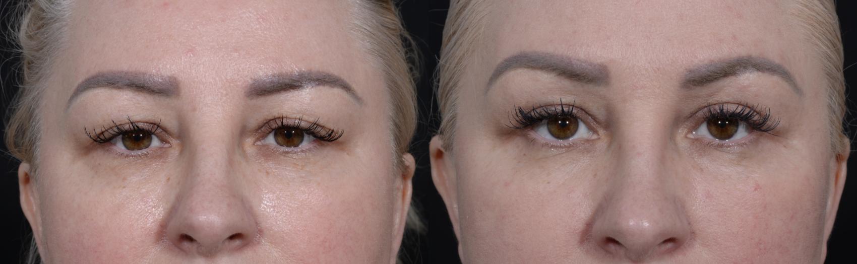 Upper and Lower Blepharoplasty Before and After Photos, Dr. Steven Hanna, Toronto