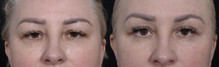 Upper and Lower Blepharoplasty Before and After Photos, Dr. Steven Hanna, Toronto