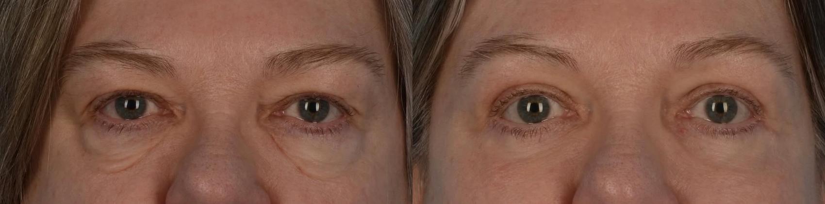 Before & After Blepharoplasty Case 324 Front View in Toronto, ON
