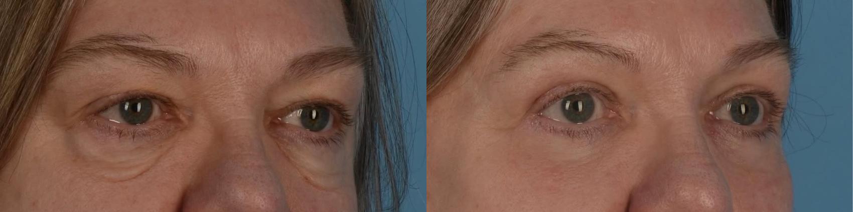 Before & After Blepharoplasty Case 324 Right Side View in Toronto, ON